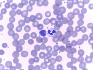 A blood smear specimen at the Petersburg lab shows lymph and mature netrophil. Photo courtesy of Liz Bacom