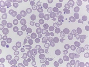 This blood test shows anemia or lack of healthy red blood cells. Photo/courtesy of PMC